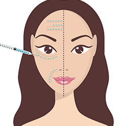 Facial Fat Grafting
